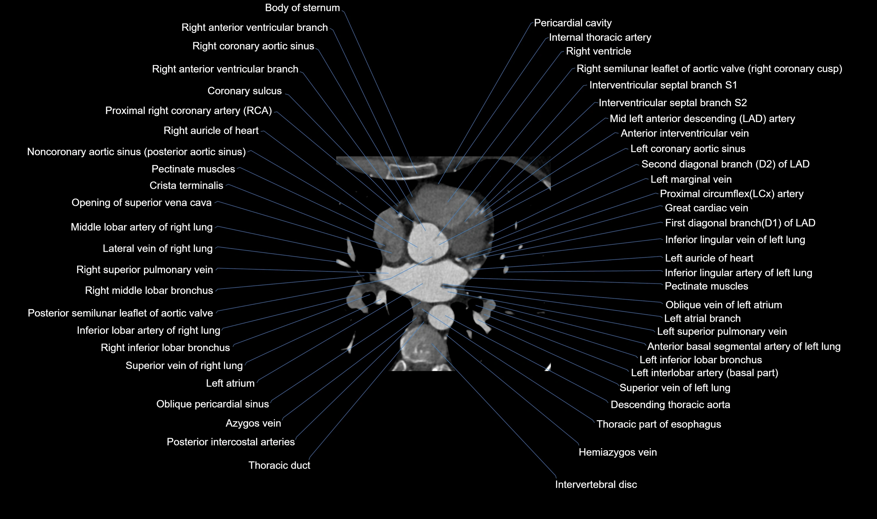 CT heart (coronary angiogram) axial view cross sectional anatomy labelled radiology image-00027.webp
